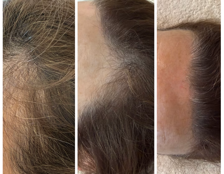 Before and after photographs showing improved hair density on the scalp