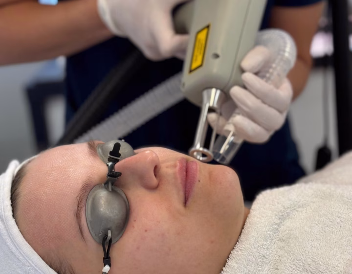 Fractional laser resurfacing being performed on a client’s face